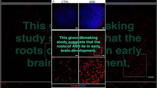 Autism Origins Found in Early Brain Development [upl. by Branden]