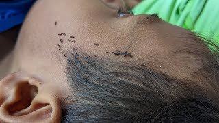 Remove lice from hair step by step  How to get out all hundred lice from his head [upl. by Borchers]