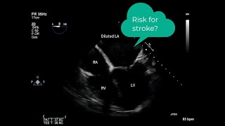 What´s the reason for the stroke Lets shed some light with echocardiography [upl. by Accissej]