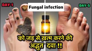 Fungal infection homeopathic treatmenthomeopathic medicine [upl. by Jarin144]