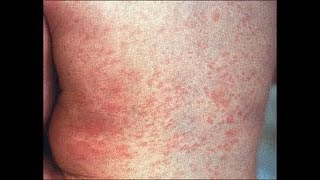 The causes and treatment of Roseola [upl. by Novoj]