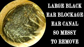 LARGE Black Ear Wax Blockage Ear Canal So Messy To Removal [upl. by Isolt]