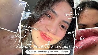 Accutane Journey  Two Months Progress Road to Clear Skin [upl. by Haorbed7]