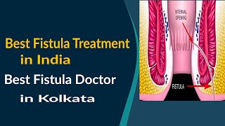 Best Fistula Treatment in India  Best Fistula Doctor in Kolkata [upl. by Erbma]