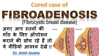 Fibroadenosis cured case [upl. by Ennairac]