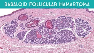 Basaloid Follicular Hamartoma linear multiple  mimic of basal cell carcinoma pathology dermpath [upl. by Acinemod895]