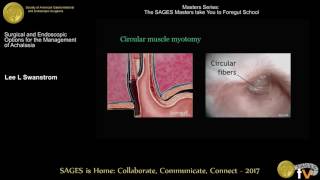 Surgical treatment for achalasia [upl. by Lory878]