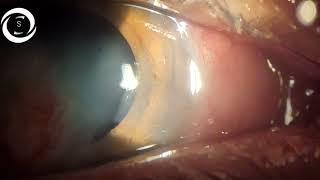 Pedicle conjunctival flap for infectious Keratitis [upl. by Murton]