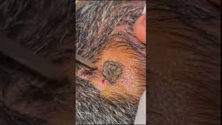 Seborrheic Keratosis Removal by Electrocautery [upl. by Rita752]