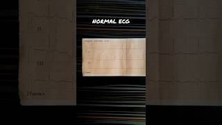 NORMAL ECG REPORT  NORMAL SINUS RHYTHM [upl. by Silyhp979]