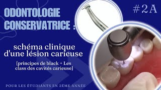 Odontologie conservatrice  Schéma clinique dune lésion carieuse part1 [upl. by Ggerg864]