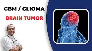 Glioma Brain Tumour Treatment  GlioblastomaGBM Cancer  दिमाग का कैंसर  Best Homeopathic Doctor [upl. by Sherline]