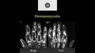 MRI of the Wrist Part 15  Wrist Inflammation [upl. by Annasus560]