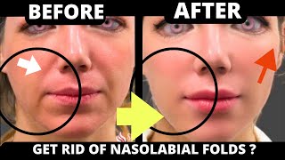 🛑 FACE EXERCISES FOR LAUGH LINES NASOLABIAL FOLDS  SAGGY SKIN JOWLS FOREHEAD LINES CHEEK LIFT [upl. by The535]