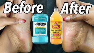 LISTERINE AND VINEGAR FOOT SOAK DOES IT REALLY WORK  SHOCKING RESULTS [upl. by Enomys281]