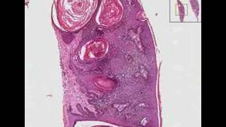 Histopathology Skin Seborrheic keratosis [upl. by Cadmar]