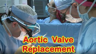 Aortic Valve Replacement Surgery [upl. by Inor]