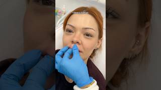 getting my fillers dissolved😳 [upl. by Herzberg]