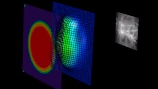 Stanford Hospitals amp Clinics laser vision correction wavefront LASIK [upl. by Hersch461]