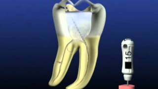 How to Use Dentsply Rotary Protaper File [upl. by Armmat175]