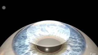 Lasik wavefront guided [upl. by Sanfourd]