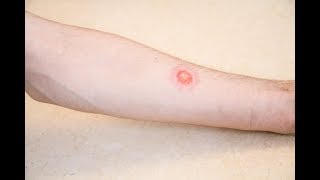 Is it ringworm Signs and symptoms [upl. by Daloris828]