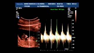 Ultrassom  Translucência Nucal  11 semanas [upl. by Ardath]