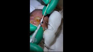 Retinopathy of Prematurity ROP Intravitreal Lucentis NICU [upl. by Aryaz]