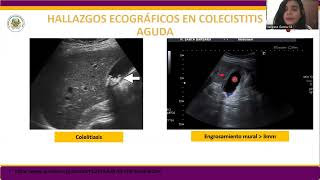 Colecistitis aguda en ecografía [upl. by Zurc]