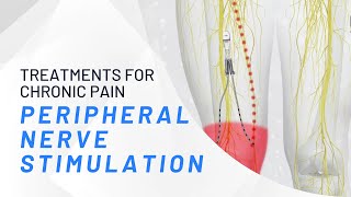 Peripheral Nerve Stimulation  What You Need To Know [upl. by Llednahs]