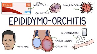 Understanding Epididymoorchitis [upl. by Einahc]