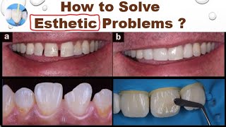 How to Solve Dental Esthetic Problems [upl. by Lalise783]