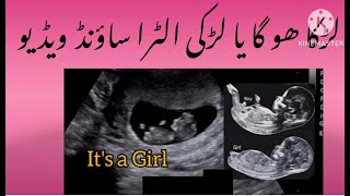 How to know the gender on ultrasound Ultrasound report baby boy or girl Anomaly scan report [upl. by Aronoel173]