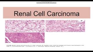 Renal cell carcinoma TypesGeneticsMorphology [upl. by Ettenad]