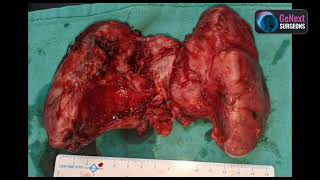 Thyroidectomy Huge Thyroid with compressive symptoms [upl. by Ttennaej]