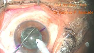 Phaco  Toric Multifocal IOL  301024 [upl. by Chessy]