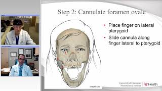 Percutaneous Procedures for Trigeminal Neuralgia Radiofrequency and Balloon Compression Rhizotomy [upl. by Demahum689]