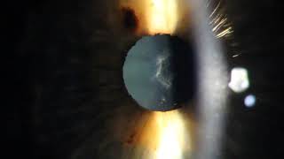 Anterior Subcapsular Cataract and Blepharitis [upl. by Dranyam3]