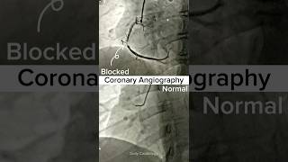 Coronary Angiography Normal vs Blocked [upl. by Mamoun]