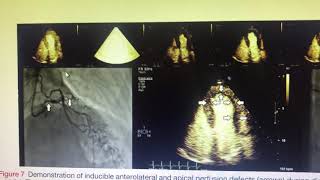 Contrast echocardiogram perfusion [upl. by Kanya791]