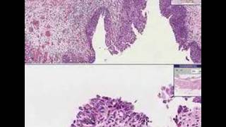 Histopathology Bladder Transitional Carcinomainsitu [upl. by Notnef210]