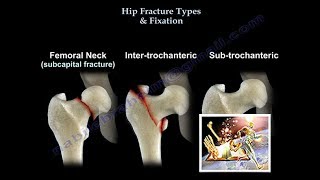 Hip Fracture Types amp Fixation  Everything You Need To Know  Dr Nabil Ebraheim [upl. by Tocci]