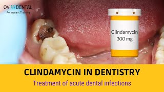 CLINDAMYCIN IN DENTISTRY  Treatment of acute dental infections [upl. by Checani930]