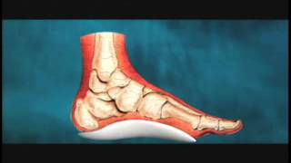 Flat Feet Causes amp Treatment  Aaron Bean DPM [upl. by Desimone416]