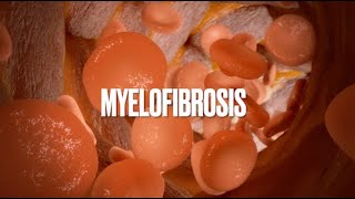 Understanding Agnogenic Myeloid MetaplasPrimary myelofibrosis PMFOsteomyelofibrosis bonemarrow [upl. by Pacian]