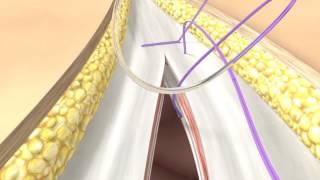 Abdominal Wall Closure BBraun [upl. by Naam]