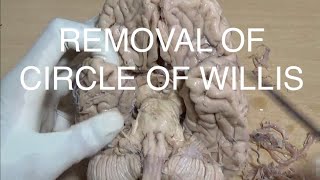 REMOVAL OF CIRCLE OF WILLIS [upl. by Farley]