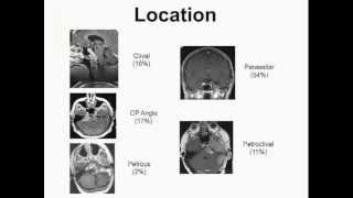 Gamma Knife Radiosurgery of Skull Base Meningiomas [upl. by Neilla]