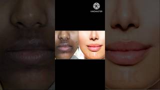 How to remove dark black patches dark spots and pigmentation around mouth [upl. by Dymphia77]