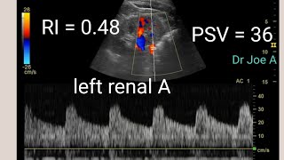 Normal renal Doppler in a hypertensive patient color Doppler ultrasound and spectral Doppler video [upl. by Ennairak532]